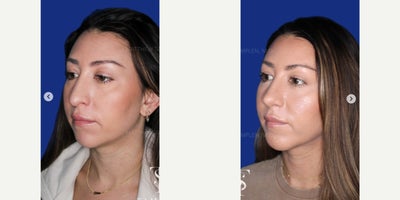 Case: 9116 - before and after photo of 35-44 year old woman treated with Revision Rhinoplasty, Chin Implant by Matthew Tamplen, MD