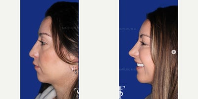 Case: 9117 - before and after photo of 35-44 year old woman treated with Revision Rhinoplasty, Chin Implant by Matthew Tamplen, MD