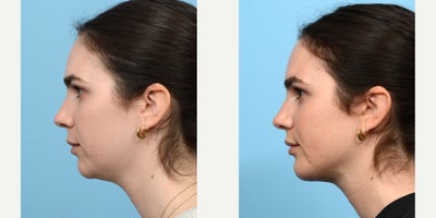 Case 9120 - 25-34 year old woman treated with Chin Implant