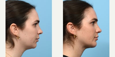 Case 9121 - 25-34 year old woman treated with Chin Implant