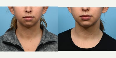 Case 9124 - 18-24 year old woman treated with Chin Implant