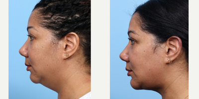 Case 9125 - 35-44 year old woman treated with Chin Implant, Chin Liposuction