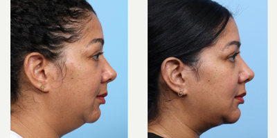 Case 9126 - 35-44 year old woman treated with Chin Implant, Chin Liposuction