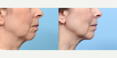 Case 9127 - 65-74 year old woman treated with Chin Implant