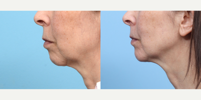 Case 9128 - 65-74 year old woman treated with Chin Implant