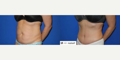 Case 913 - Woman treated with Tummy Tuck