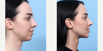 Case 9131 - 25-34 year old woman treated with Chin Implant, Chin Liposuction