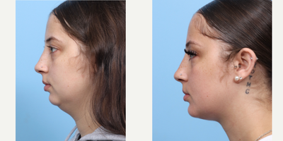 Case 9132 - 25-34 year old woman treated with Chin Implant, Chin Liposuction