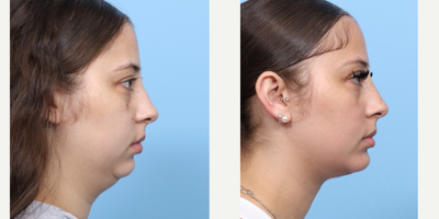 Case 9133 - 25-34 year old woman treated with Chin Implant, Chin Liposuction