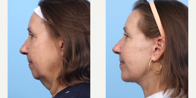 Case 9134 - 55-64 year old woman treated with Deep Plane Facelift, Facelift, Chin Implant