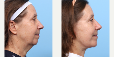 Case 9135 - 55-64 year old woman treated with Deep Plane Facelift, Facelift, Chin Implant