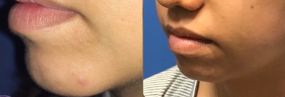 Case 9138 - Woman treated with Chin Implant