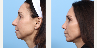 Case 9139 - 45-54 year old woman treated with Rhinoplasty, Chin Implant