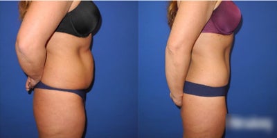 Case 914 - Woman treated with Tummy Tuck