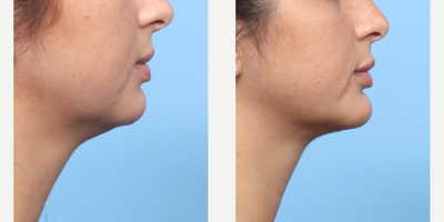 Case 9141 - 25-34 year old woman treated with Chin Implant, Chin Liposuction