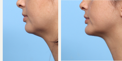 Case 9142 - 25-34 year old woman treated with Chin Implant, Chin Liposuction