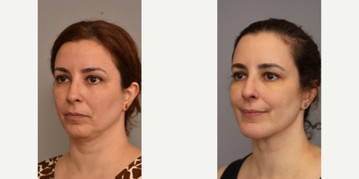 Case 9144 - Woman treated with Chin Implant