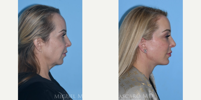 Case 9146 - 46 year old woman treated with Chin Implant