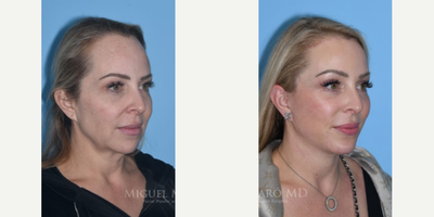 Case 9147 - 46 year old woman treated with Chin Implant