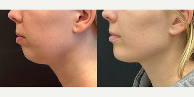 Case 9148 - Woman treated with Chin Implant
