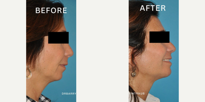 Case 9149 - Woman treated with Chin Implant