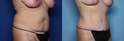 Case 915 - 45 year old woman treated with Tummy Tuck, Liposuction