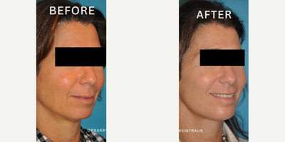 Case 9150 - Woman treated with Chin Implant