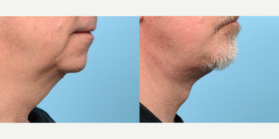 Case 9151 - 55-64 year old man treated with Deep Plane Facelift, Chin Implant