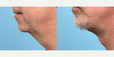 Case 9152 - 55-64 year old man treated with Deep Plane Facelift, Chin Implant