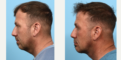 Case 9153 - 45-54 year old man treated with Neck Lift, Chin Implant