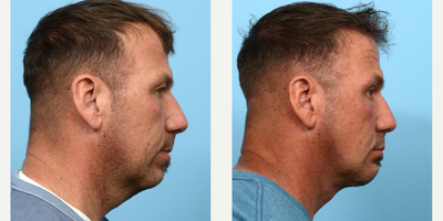 Case 9154 - 45-54 year old man treated with Neck Lift, Chin Implant