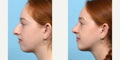 Case 9155 - 18-24 year old woman treated with Chin Implant, Rhinoplasty