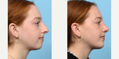 Case 9156 - 18-24 year old woman treated with Chin Implant, Rhinoplasty