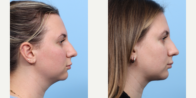 Case 9157 - 25-34 year old woman treated with Chin Implant, Chin Liposuction