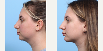 Case 9158 - 25-34 year old woman treated with Chin Implant, Chin Liposuction