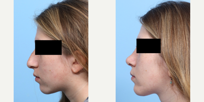 Case 9159 - 17 or under year old woman treated with Rhinoplasty, Chin Implant