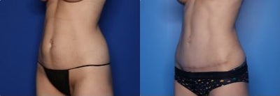 Case 916 - 41 year old woman treated with Tummy Tuck, Liposuction