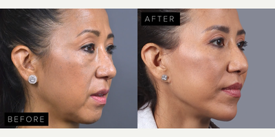 Case 9161 - Woman treated with Eyelid Surgery, Deep Plane Facelift, Facial Fat Transfer, Lip Lift, Chin Implant