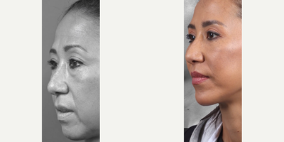 Case 9162 - Woman treated with Eyelid Surgery, Deep Plane Facelift, Facial Fat Transfer, Lip Lift, Chin Implant