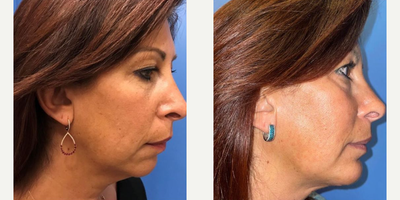 Case 9163 - Woman treated with Chin Implant