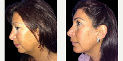 Case 9164 - Woman treated with Chin Implant