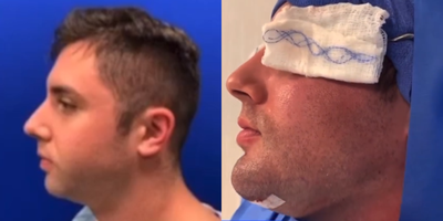 Case 9165 - Woman treated with Chin Implant