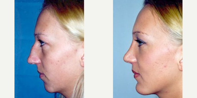 Case 9166 - Woman treated with Chin Implant