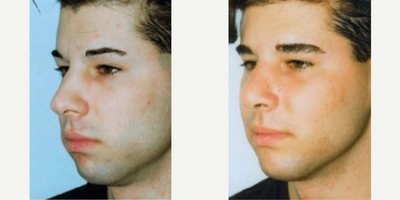 Case 9167 - Man treated with Chin Implant