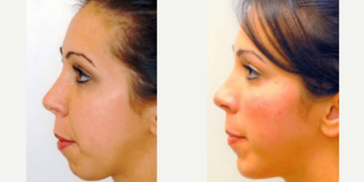 Case 9168 - Woman treated with Chin Implant