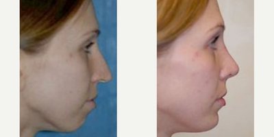 Case 9169 - Woman treated with Chin Implant