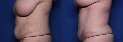 Case 917 - 54 year old woman treated with Tummy Tuck, Liposuction