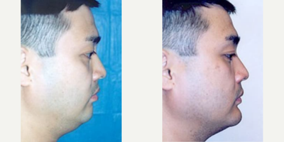 Case 9170 - Man treated with Chin Implant