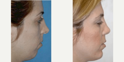 Case 9171 - Woman treated with Chin Implant