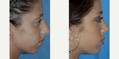 Case 9172 - Woman treated with Chin Implant